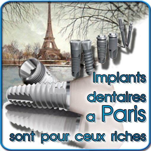 Implants dentaires Paris sont pour ceux riches!
