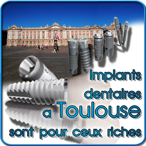Implants dentaires Toulouse sont pour les gens aisés!