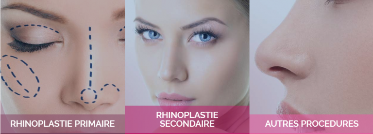 rhinoplastie