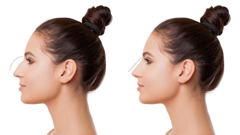 Rhinoplastie en Tunisie : Retrouvez un joli nez