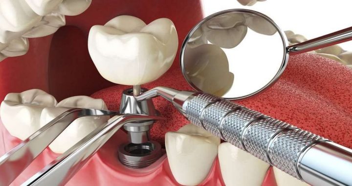 5 façons de réduire le coût de vos implants dentaires