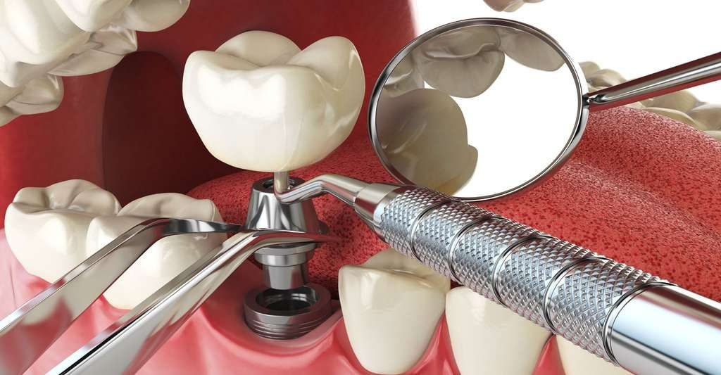 réduire le coût de vos implants dentaires