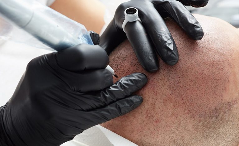 Tricopigmentation Hainaut, un cabinet fiable pour votre tatouage capillaire