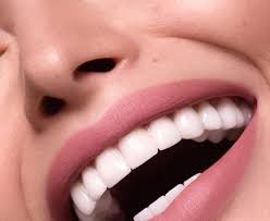 FAQ facettes dentaires : durée, douleur et préparation des dents