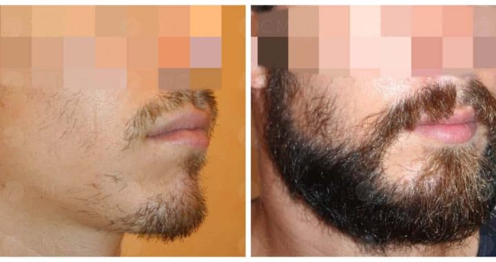 Greffe de barbe : éliminer les zones clairsemées