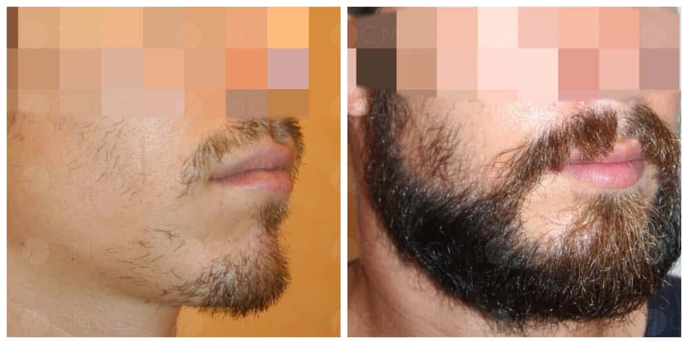 greffe de barbe