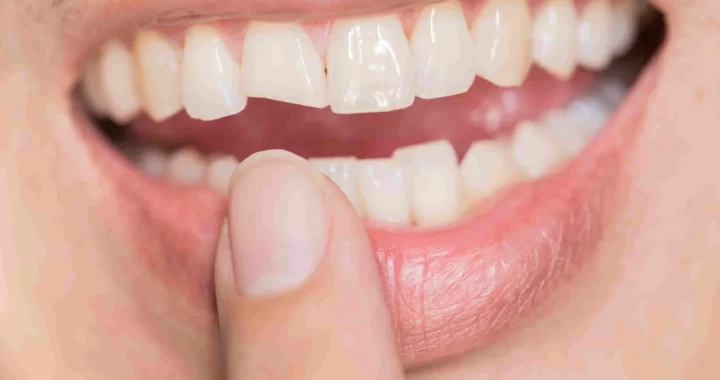 Dents cassées, ébréchées ou fracturées : causes et problèmes qu’elles engendrent